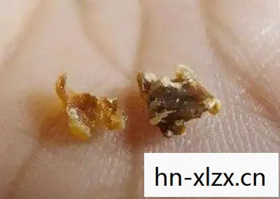 耳屎挖掘者2,探索耳朵深处的奥秘 耳屎挖掘者2,探索耳朵深处的奥秘