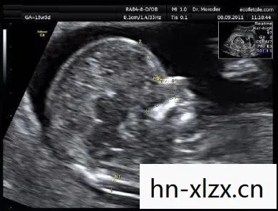 怀孕NT是什么意思呢,网络术语NT的多样含义解析 怀孕NT是什么意思呢,网络术语NT的多样含义解析